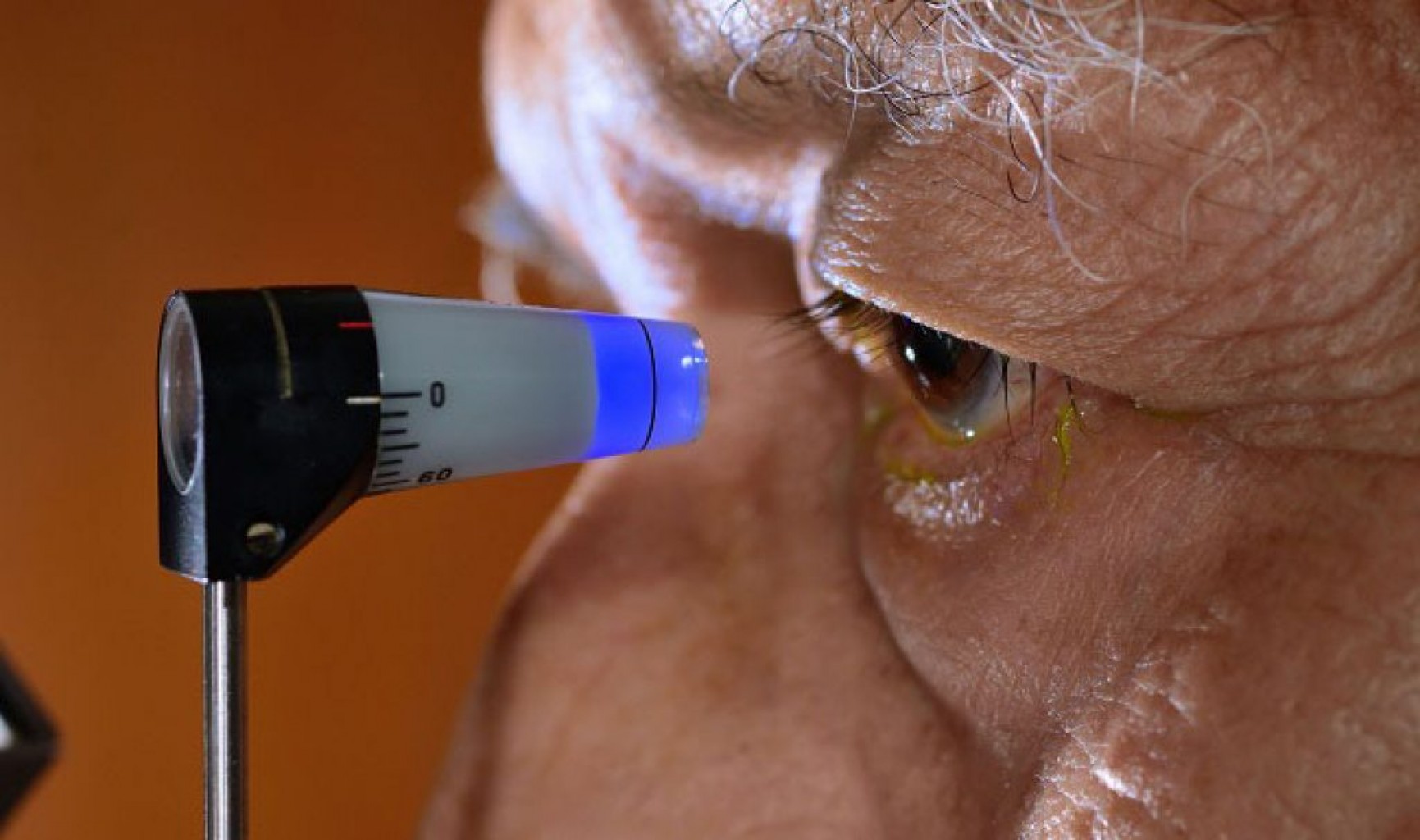 ¿Qué es el Glaucoma?