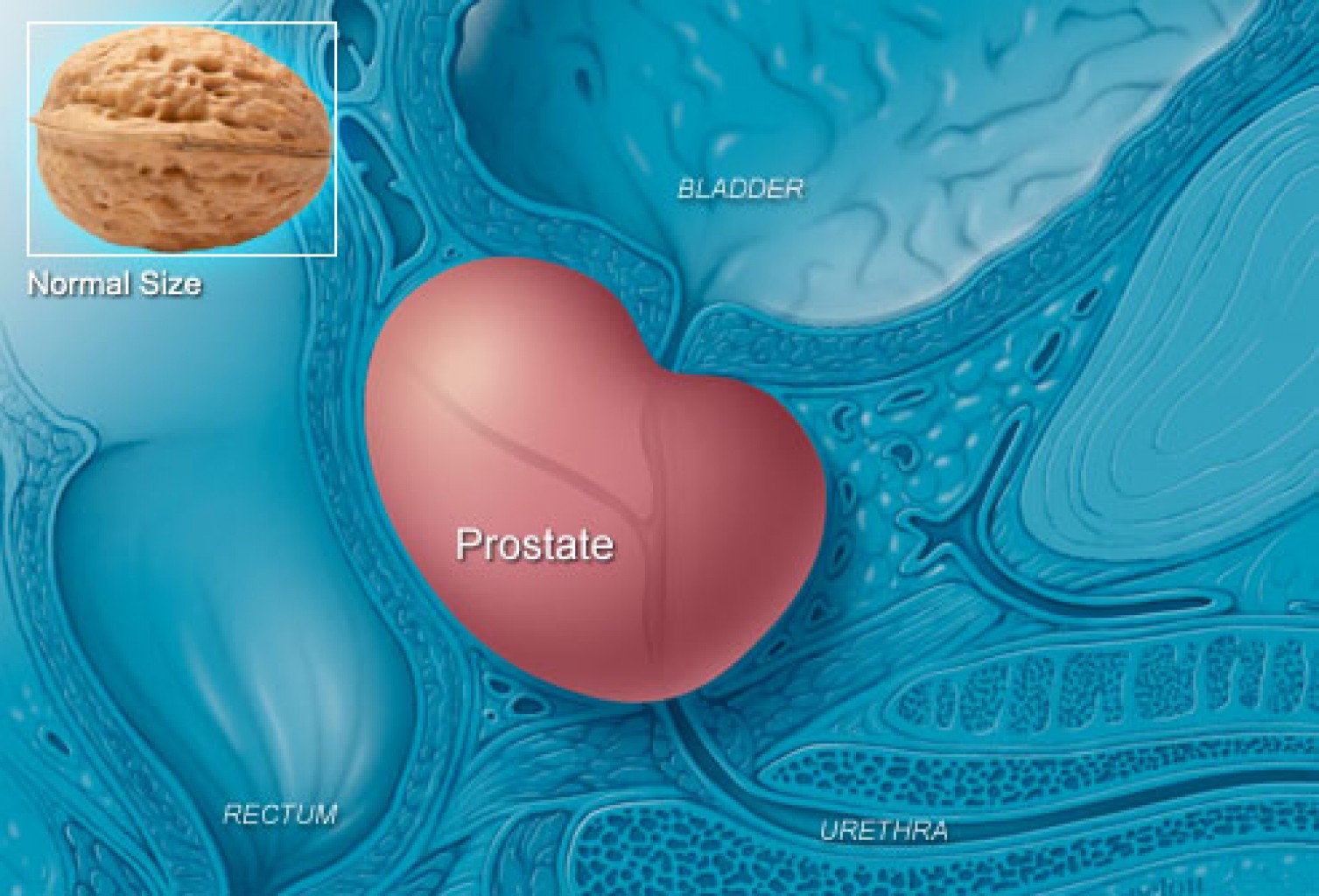 Creando conciencia del cáncer  de próstata  