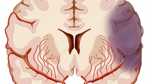 Las mujeres enfrentan riesgos únicos de accidente cerebrovascular