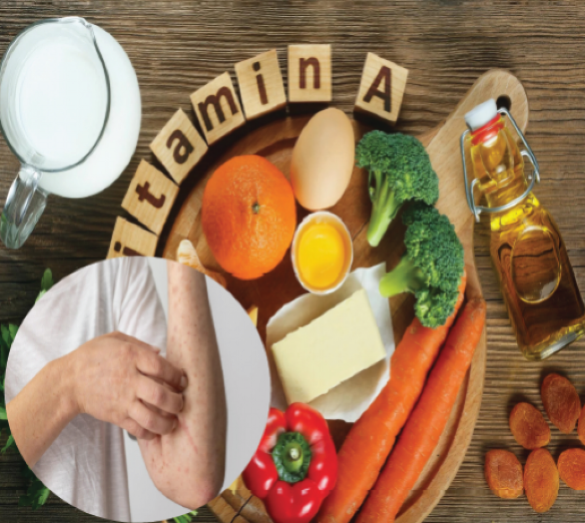 Expertos en salud preocupados por recomendación de vitamina A contra el sarampión Expertos en salud preocupados por recomendación de vitamina A contra el sarampión