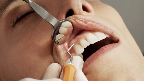“Dientes de Ozempic”, el daño colateral de los medicamentos para bajar de peso “Dientes de Ozempic”, el daño colateral de los medicamentos para bajar de peso