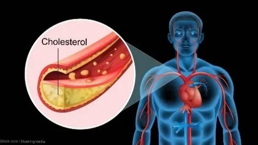 Cómo entender el colesterol: lo que necesita saber para un corazón saludable
