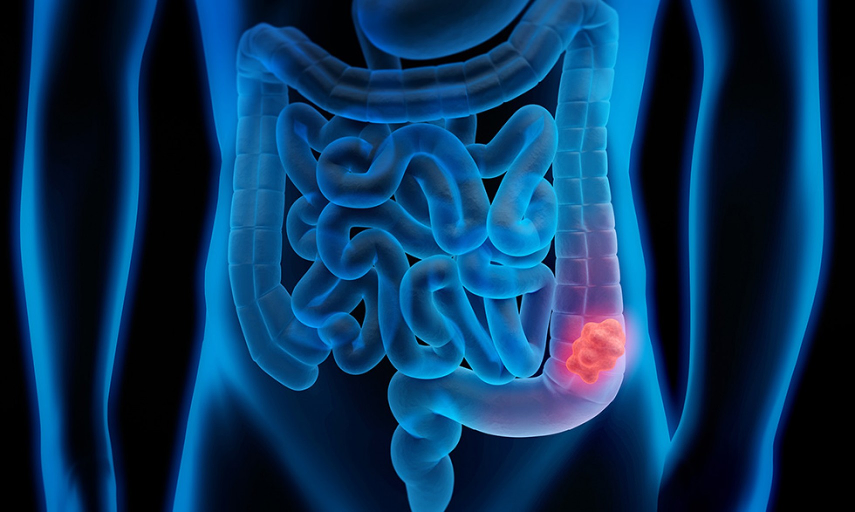 Aumenta el cáncer colorrectal en menores de 50 años en EE. UU.