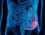 Aumenta el cáncer colorrectal en menores de 50 años en EE. UU.