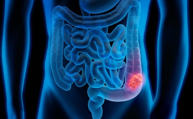 Aumenta el cáncer colorrectal en menores de 50 años en EE. UU.